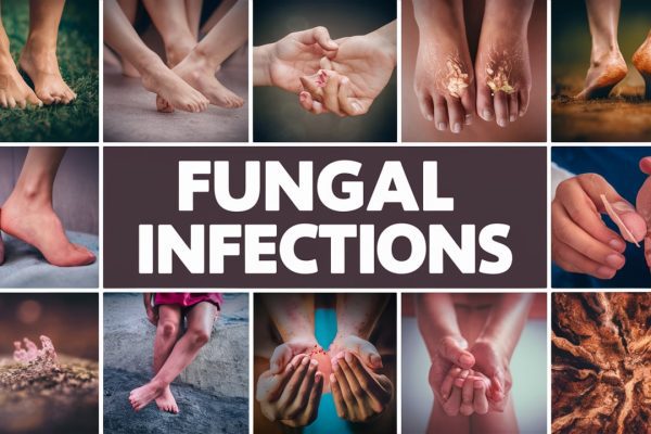 Fungal infections