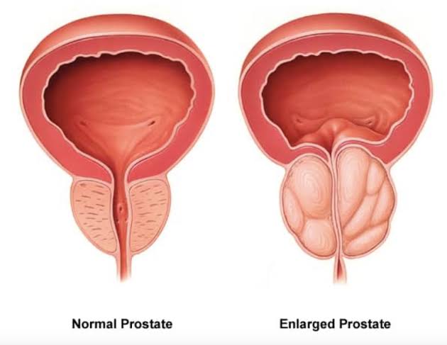 Prostate Cancer 